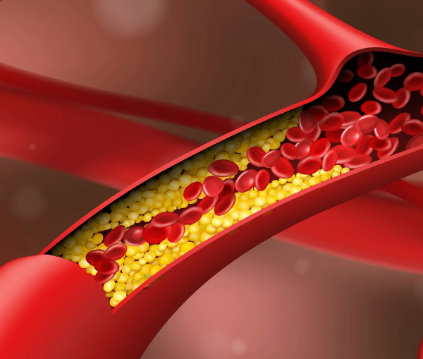 Heart Disease Prevention