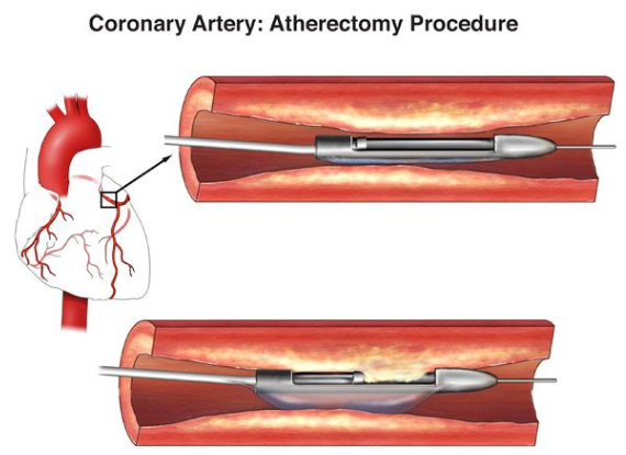 Atherectomy 