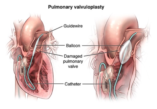 Valvuloplasty Surgery