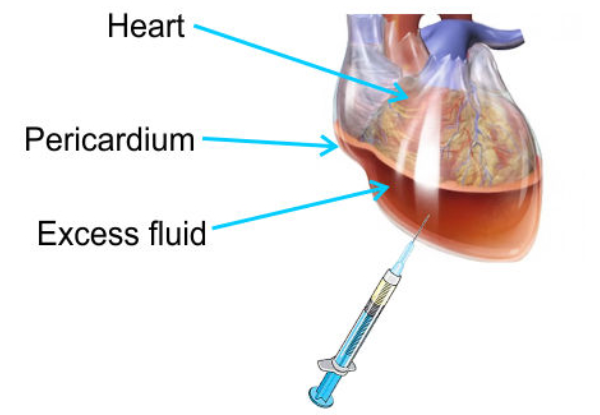 Pericardiocentesis