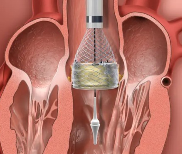 Transcatheter aortic valve replacement 