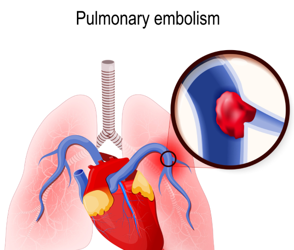 Pulmonary Embolism 