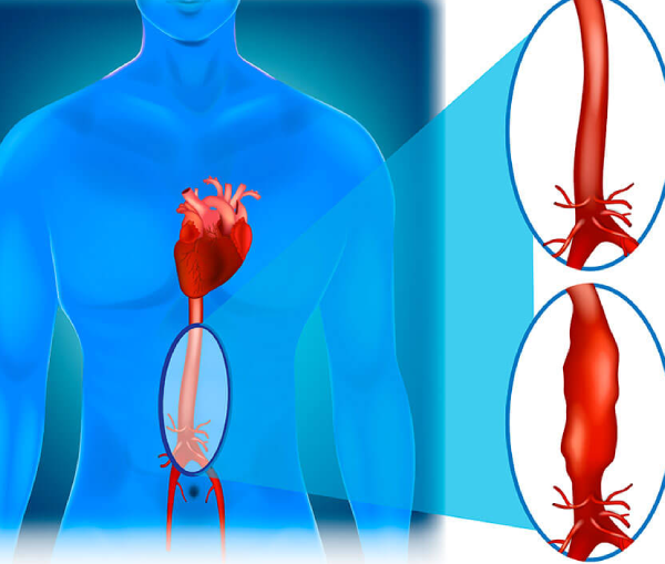 Aortic Aneurysm