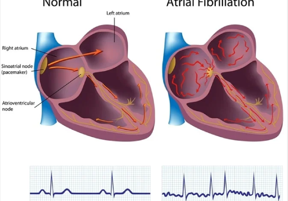 Atrial Fibrillation