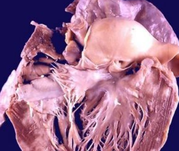 Cardiac Sarcoidosis