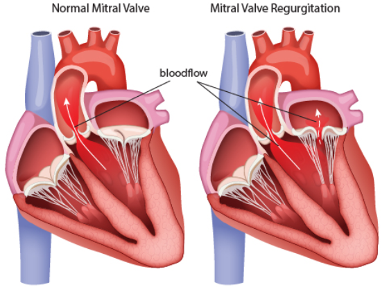 Mitral Regurgitation