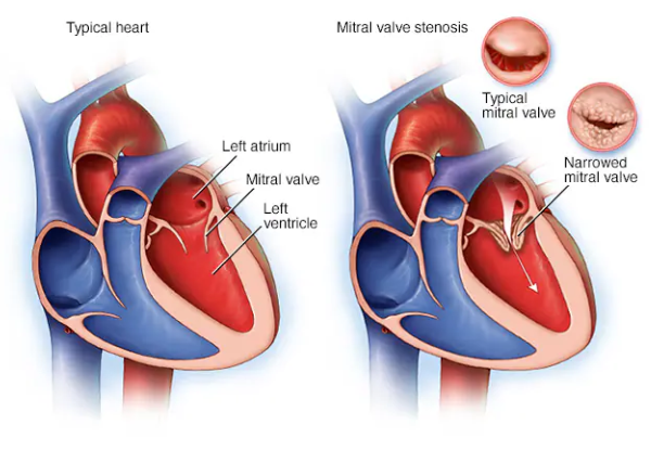 Mitral Stenosis